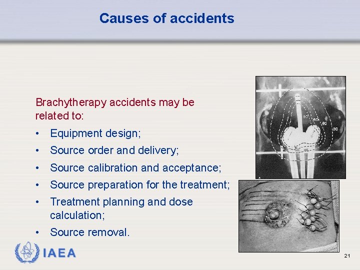 Causes of accidents Brachytherapy accidents may be related to: • Equipment design; • Source
