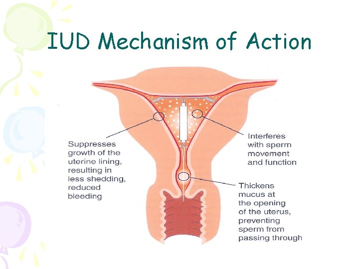 IUD Mechanism of Action 