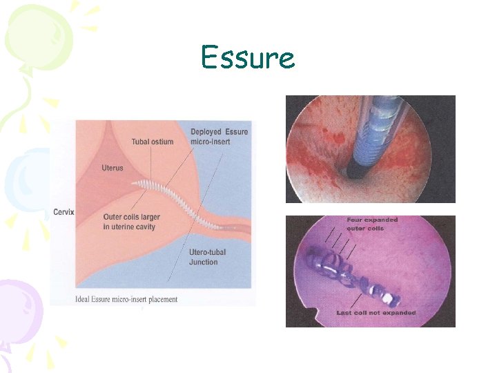 Essure 