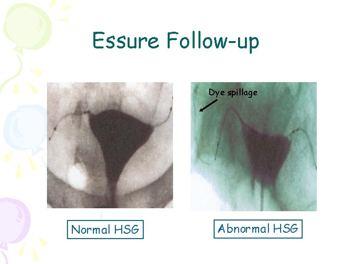 Essure Follow-up Dye spillage Normal HSG Abnormal HSG 