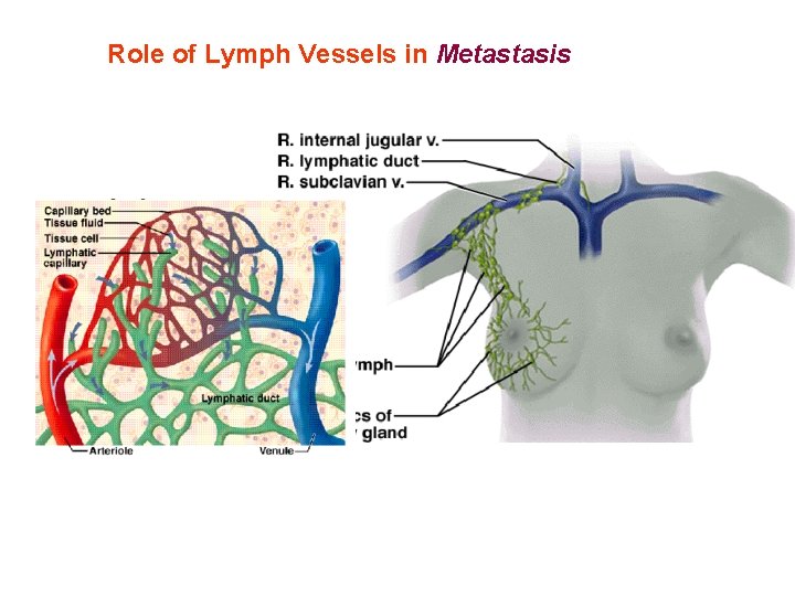 Role of Lymph Vessels in Metastasis 