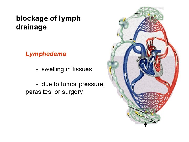 blockage of lymph drainage Lymphedema - swelling in tissues - due to tumor pressure,