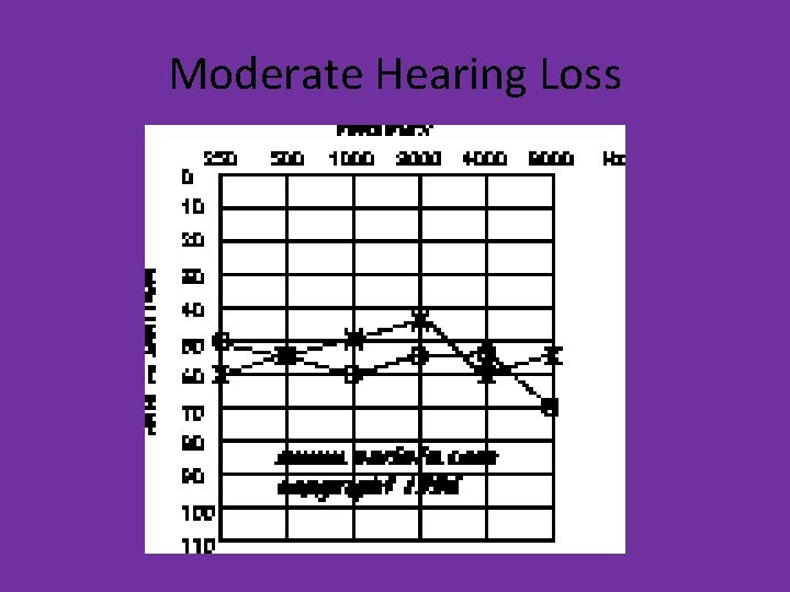 Moderate Hearing Loss 