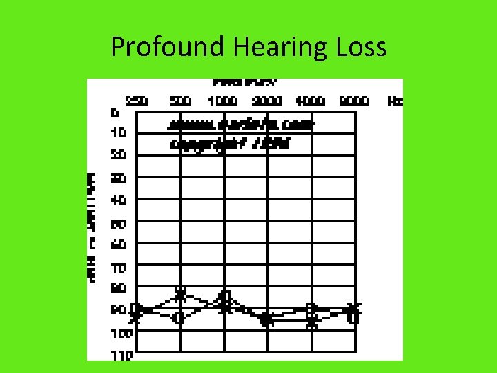 Profound Hearing Loss 