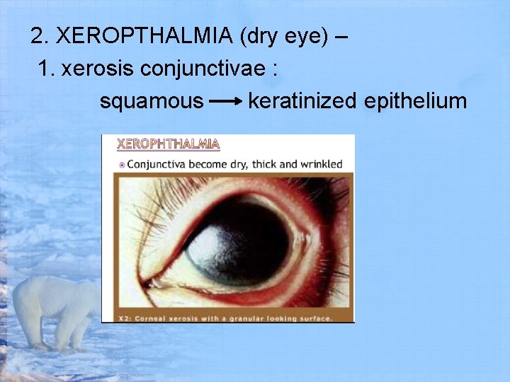 2. XEROPTHALMIA (dry eye) – 1. xerosis conjunctivae : squamous keratinized epithelium 
