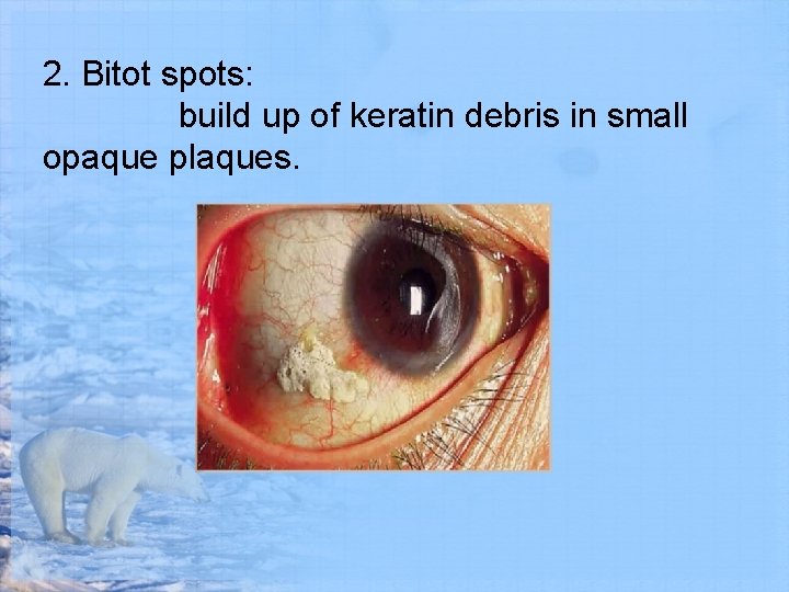 2. Bitot spots: build up of keratin debris in small opaque plaques. 