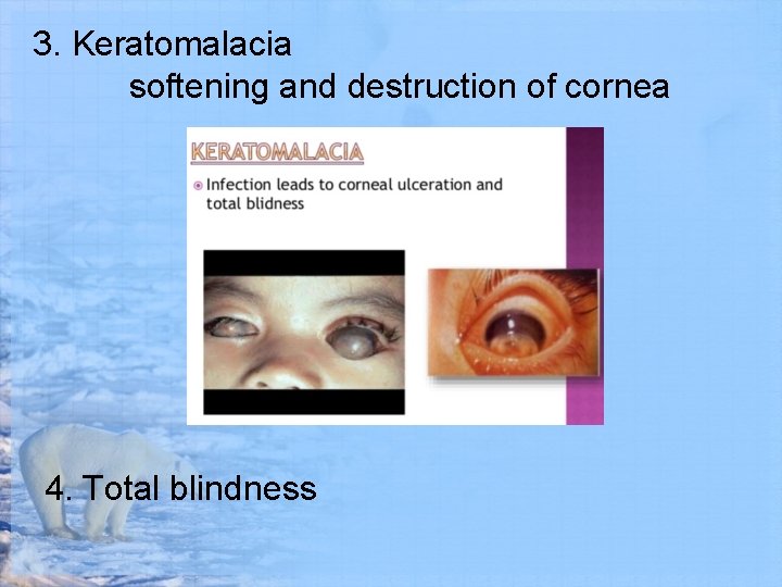 3. Keratomalacia softening and destruction of cornea 4. Total blindness 