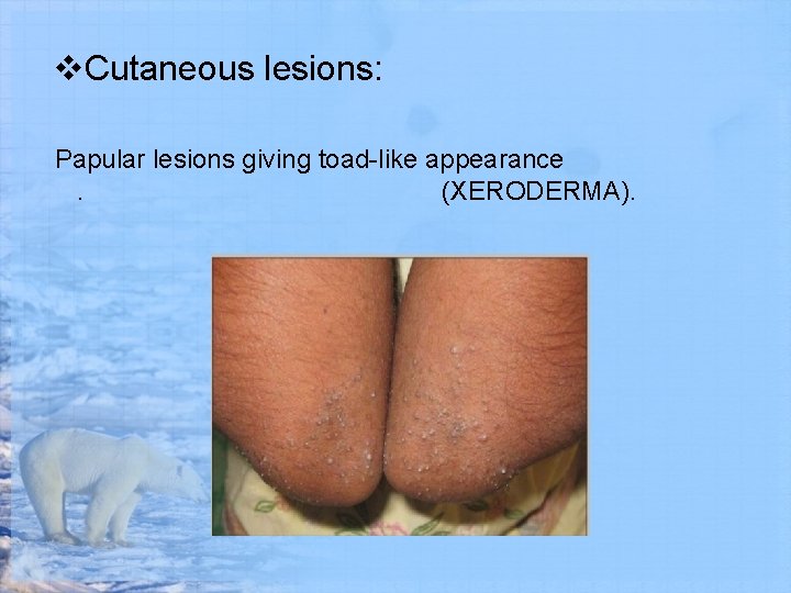 v. Cutaneous lesions: Papular lesions giving toad-like appearance. (XERODERMA). 