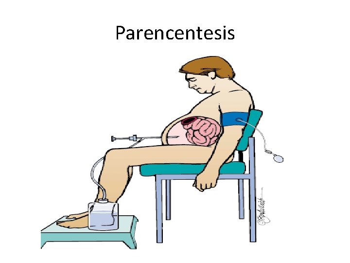 Parencentesis Parencentesis