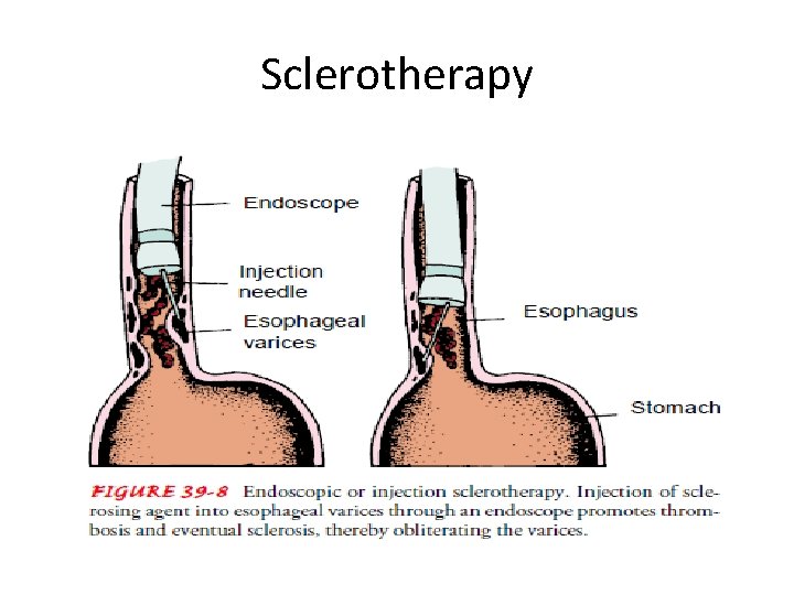 Sclerotherapy Sclerotherapy