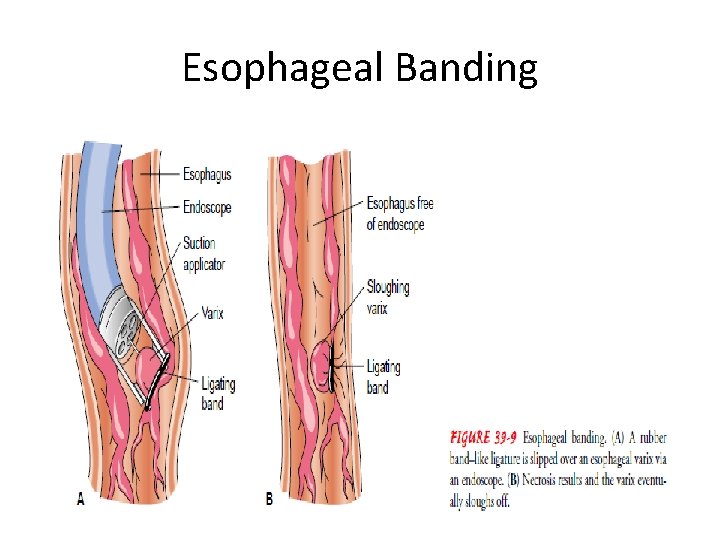 Esophageal Banding Esophageal Banding