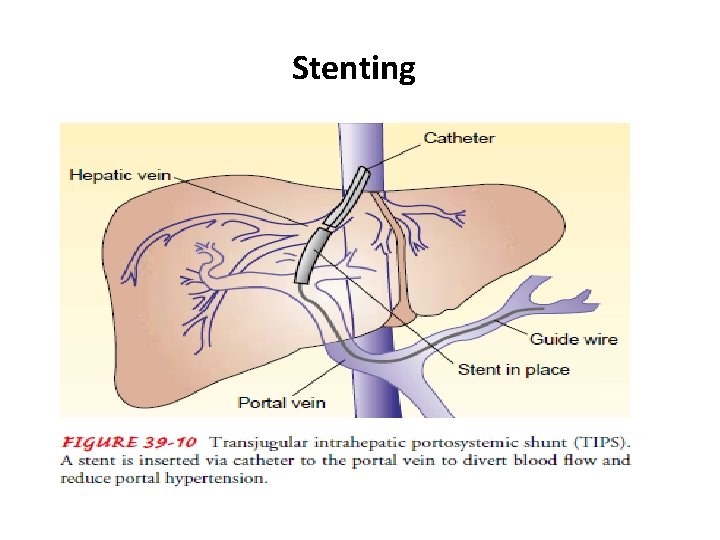 Stenting Stenting