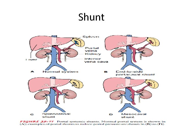 Shunt Shunt