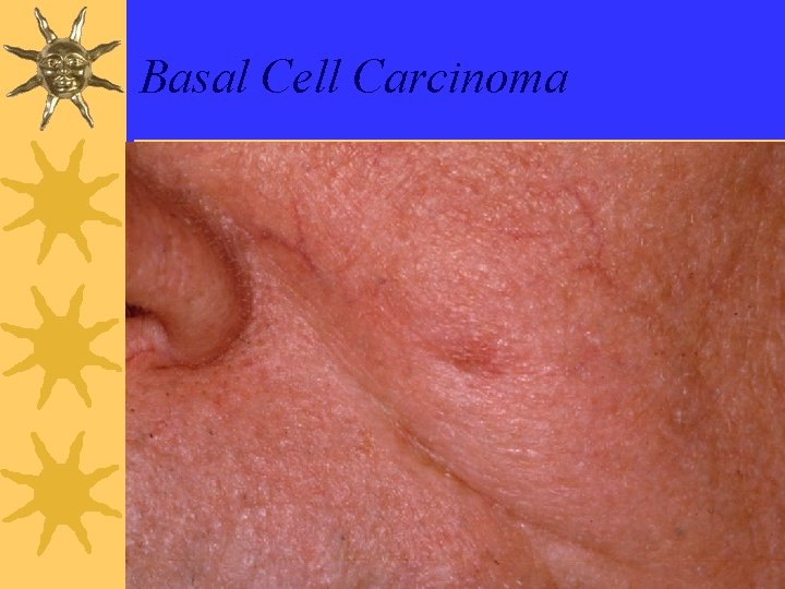 Basal Cell Carcinoma 