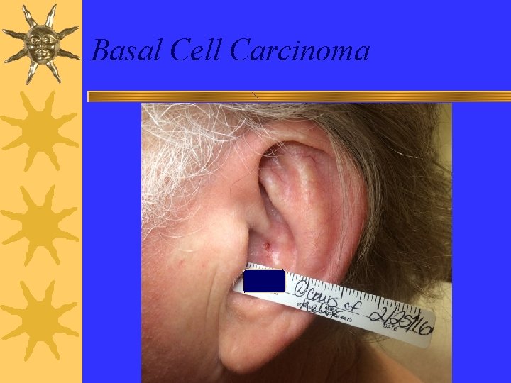 Basal Cell Carcinoma 