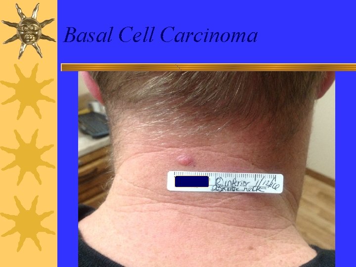 Basal Cell Carcinoma 