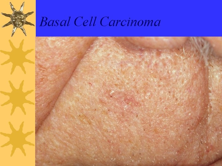 Basal Cell Carcinoma 