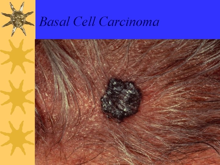 Basal Cell Carcinoma 