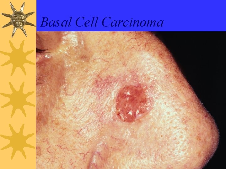 Basal Cell Carcinoma 