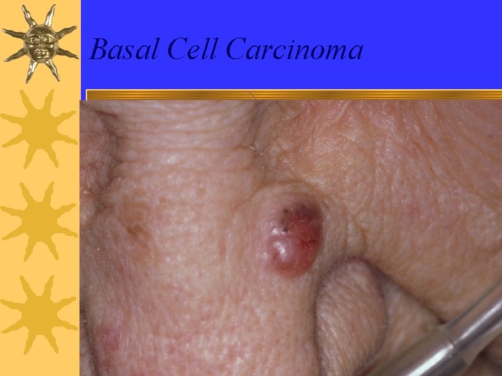 Basal Cell Carcinoma 