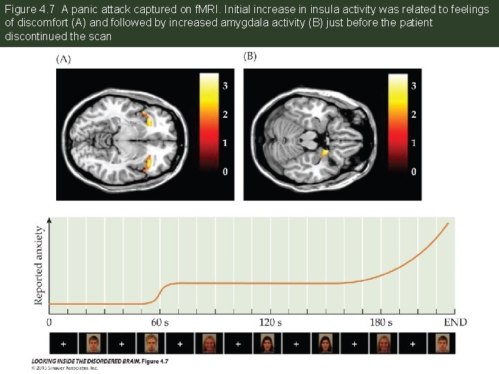 Figure 4. 7 A panic attack captured on f. MRI. Initial increase in insula