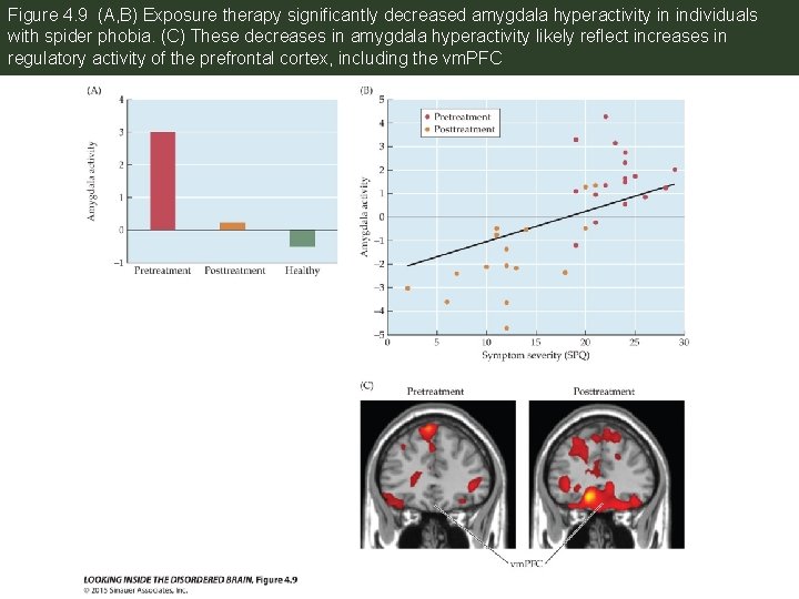 Figure 4. 9 (A, B) Exposure therapy significantly decreased amygdala hyperactivity in individuals with