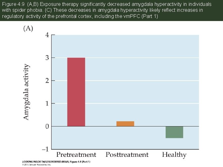 Figure 4. 9 (A, B) Exposure therapy significantly decreased amygdala hyperactivity in individuals with