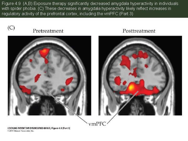 Figure 4. 9 (A, B) Exposure therapy significantly decreased amygdala hyperactivity in individuals with