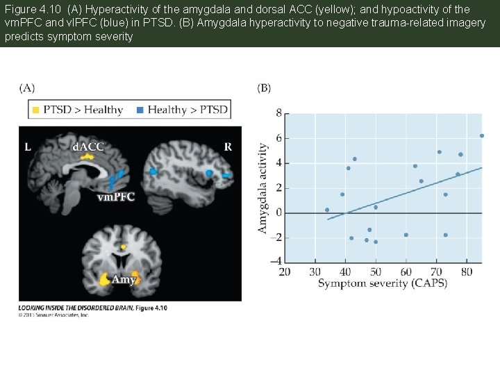 Figure 4. 10 (A) Hyperactivity of the amygdala and dorsal ACC (yellow); and hypoactivity