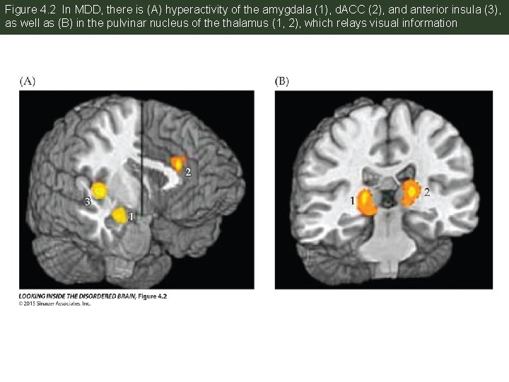 Figure 4. 2 In MDD, there is (A) hyperactivity of the amygdala (1), d.