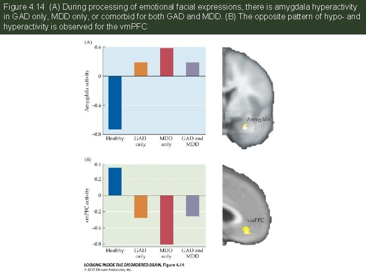 Figure 4. 14 (A) During processing of emotional facial expressions, there is amygdala hyperactivity
