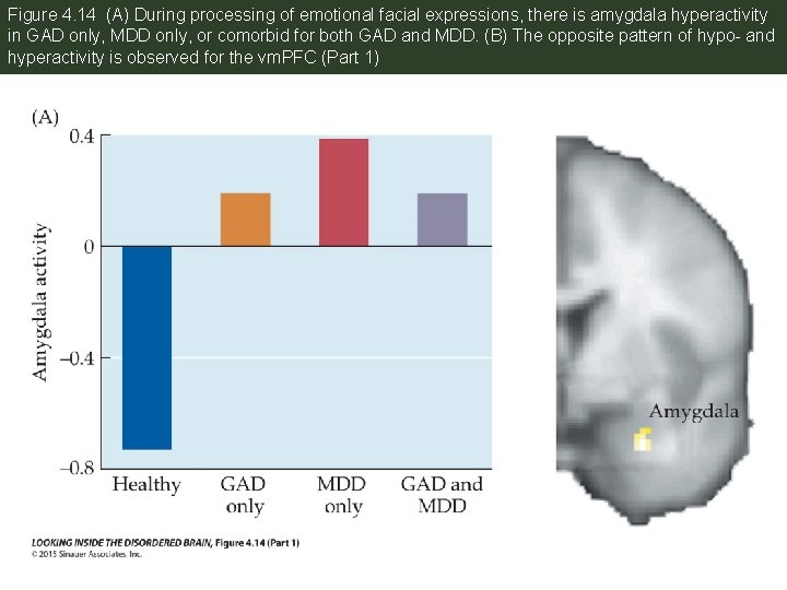 Figure 4. 14 (A) During processing of emotional facial expressions, there is amygdala hyperactivity
