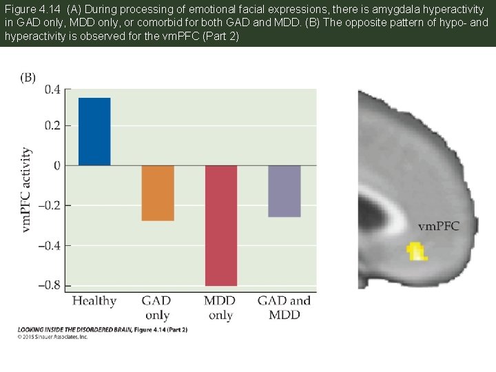Figure 4. 14 (A) During processing of emotional facial expressions, there is amygdala hyperactivity