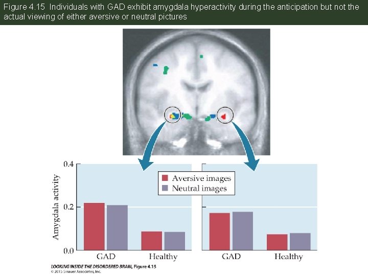 Figure 4. 15 Individuals with GAD exhibit amygdala hyperactivity during the anticipation but not