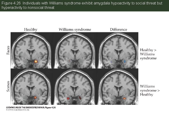 Figure 4. 26 Individuals with Williams syndrome exhibit amygdala hypoactivity to social threat but