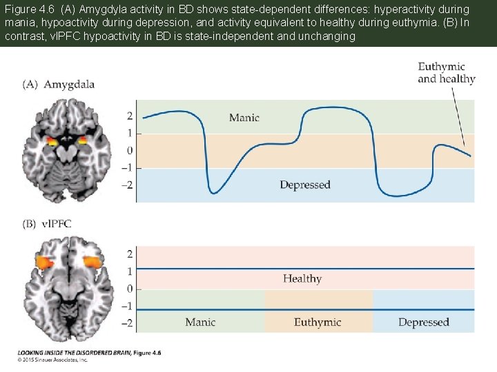 Figure 4. 6 (A) Amygdyla activity in BD shows state-dependent differences: hyperactivity during mania,