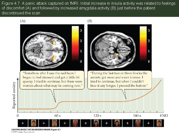 Figure 4. 7 A panic attack captured on f. MRI. Initial increase in insula