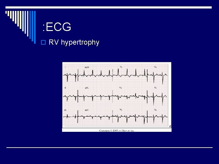 : ECG o RV hypertrophy 