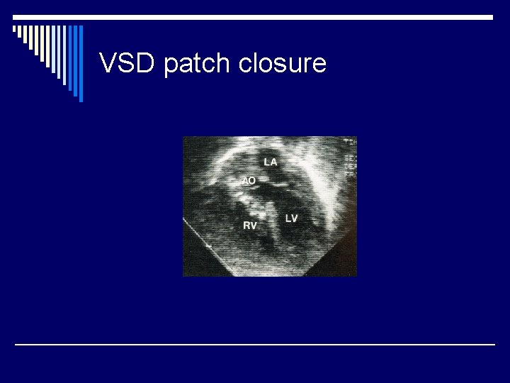 VSD patch closure 