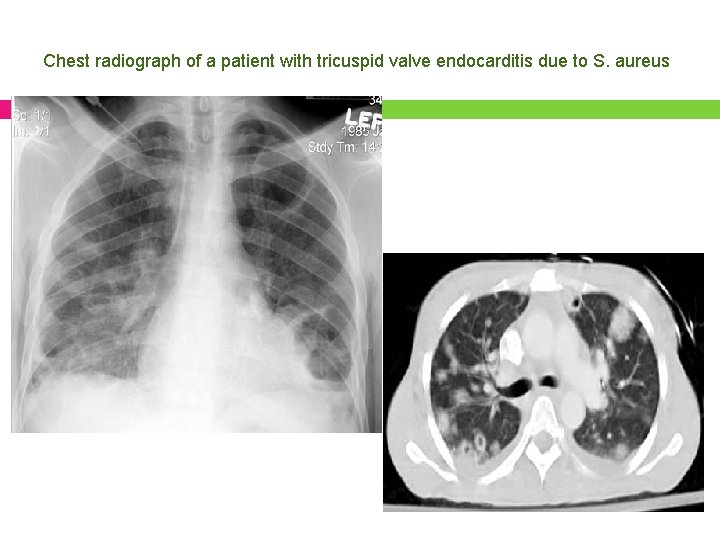 Chest radiograph of a patient with tricuspid valve endocarditis due to S. aureus 