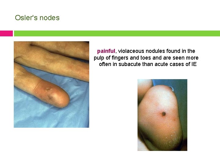 Osler's nodes painful, violaceous nodules found in the pulp of fingers and toes and