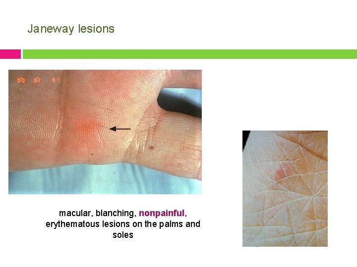 Janeway lesions macular, blanching, nonpainful, erythematous lesions on the palms and soles 