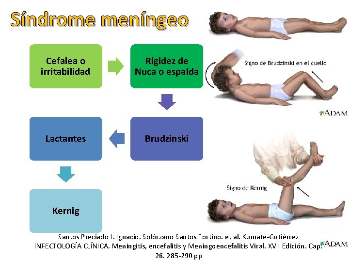 Síndrome meníngeo Cefalea o irritabilidad Rigidez de Nuca o espalda Lactantes Brudzinski Kernig Santos