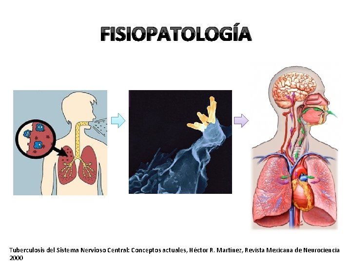 FISIOPATOLOGÍA Tuberculosis del Sistema Nervioso Central: Conceptos actuales, Héctor R. Martínez, Revista Mexicana de