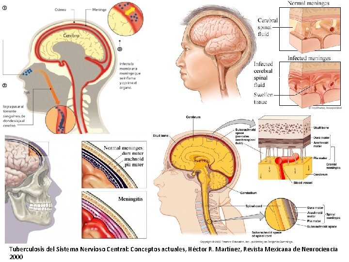 Tuberculosis del Sistema Nervioso Central: Conceptos actuales, Héctor R. Martínez, Revista Mexicana de Neurociencia