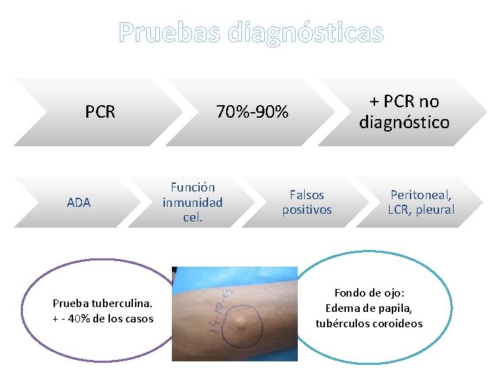 Pruebas diagnósticas PCR ADA Prueba tuberculina. + - 40% de los casos + PCR