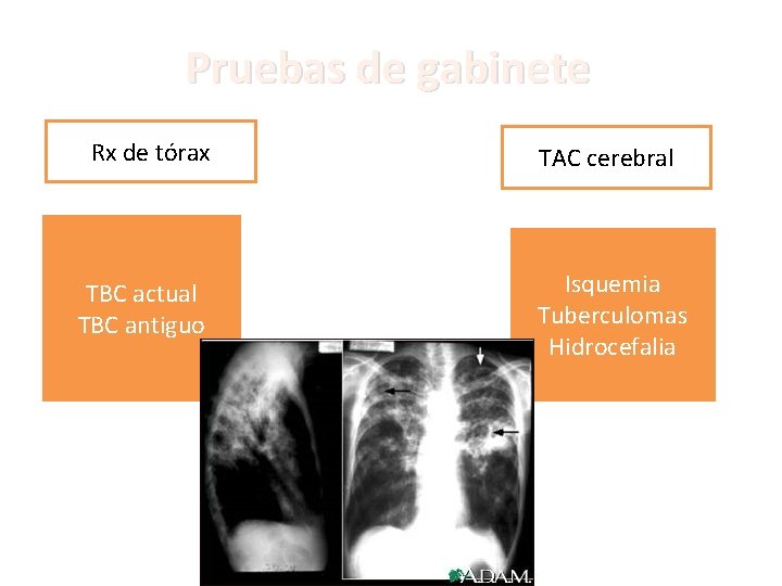 Pruebas de gabinete Rx de tórax TBC actual TBC antiguo TAC cerebral Isquemia Tuberculomas