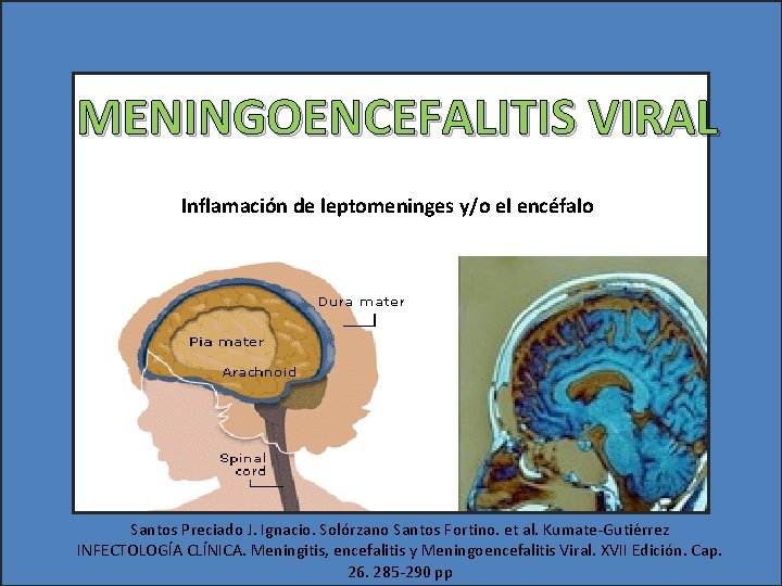 MENINGOENCEFALITIS VIRAL Inflamación de leptomeninges y/o el encéfalo Santos Preciado J. Ignacio. Solórzano Santos