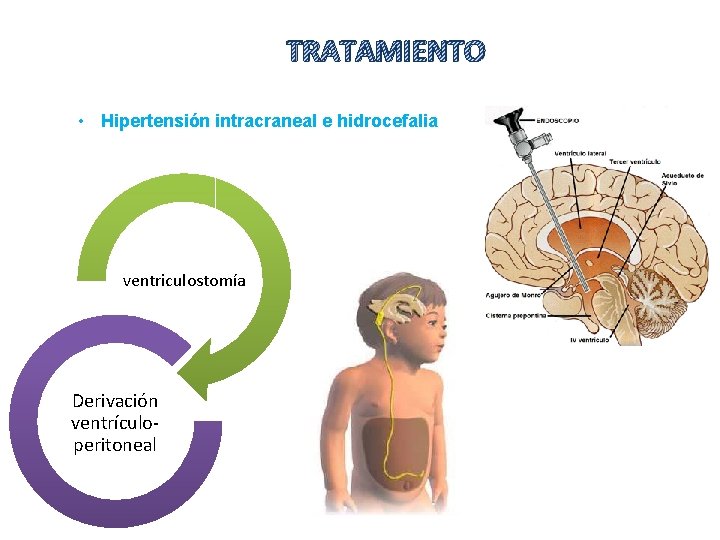 TRATAMIENTO • Hipertensión intracraneal e hidrocefalia ventriculostomía Derivación ventrículoperitoneal 