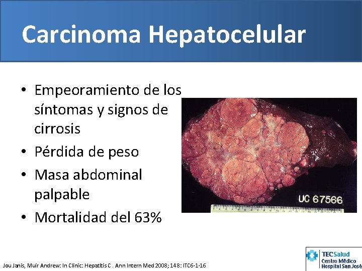 Carcinoma Hepatocelular • Empeoramiento de los síntomas y signos de cirrosis • Pérdida de